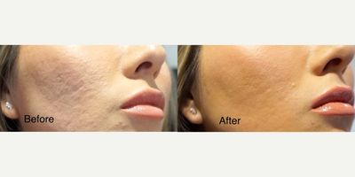 Woman treated with Venus Viva, MiXto Laser - Details - Acne treated with lasers and fillers