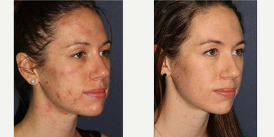 25-34 year old woman treated with Photodynamic Therapy - Photodynamic Therapy (PDT) treatment for acne and acne scarring on the face and neck.