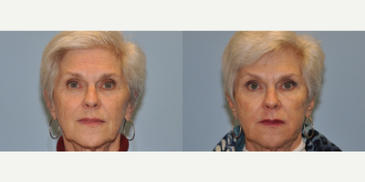 75+ woman treated with Radiesse, Juvederm, Botox - This patient was treated with Radiesse, Juvederm, and Botox.