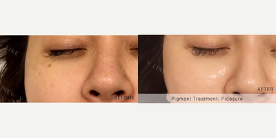 25-34 year old woman treated with PicoSure - 25-34 year old woman treated with PicoSure, 3 Sessions