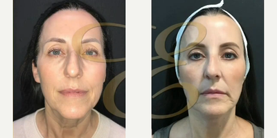 Woman treated with Mini Facelift - Woman treated with Mini Facelift