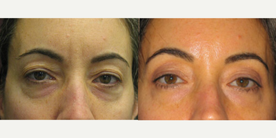 51 year old woman treated with Thermage - 51 year old woman treated with Thermage to eyes shown after one treatment