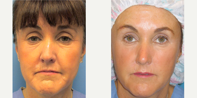 Woman treated with Thermage - Woman treated with Thermage