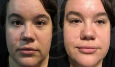 Woman treated with Lip Fillers, Juvederm - Woman treated with Lip Fillers, Juvederm
