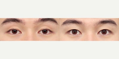 25-34 year old man treated with Double Eyelid Surgery, Eyelid Surgery, Ptosis Surgery, Canthoplasty - He had non-incisional eyelid with ptosis correction (revision) with epicanthoplasty