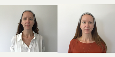 35-44 year old woman treated with Sofwave - Sofwave procedure full face