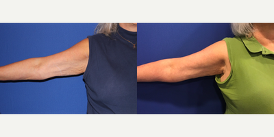 65-74 year old woman treated with Ultherapy - My 68 year old patient wanted a non invasive skin tightening procedure to tone and tighten inner arms and thighs. Here she is 8 months post treatment after 1 session.