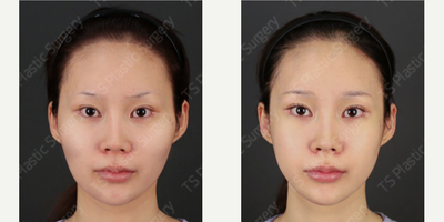 25-34 year old woman treated with Asian Rhinoplasty, Botox, Cheekbone Reduction, Facial Feminization Surgery, Jaw Reduction - - Malar(Cheekbone)- Square Jaw- Rhinoplasty