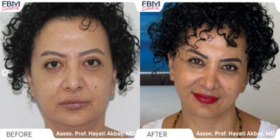 45-54 year old woman treated with Deep Plane Facelift, Facelift, Double Eyelid Surgery, Eyelid Surgery - 45-54 year old woman treated with Facelift, Deep Plane Facelift, Facial Fat Transfer, Double Eyelid Surgery, Rhinoplasty