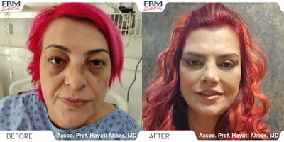 45-54 year old woman treated with Facelift, Deep Plane Facelift, Facial Fat Transfer, Double Eyelid Surgery, Rhinoplasty - 45-54 year old woman treated with Facelift, Deep Plane Facelift, Facial Fat Transfer, Double Eyelid Surgery, Rhinoplasty