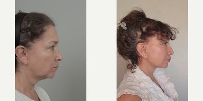 55-64 year old woman treated with AccuLift, Facelift, Lip Fillers, SMAS Facelift - .