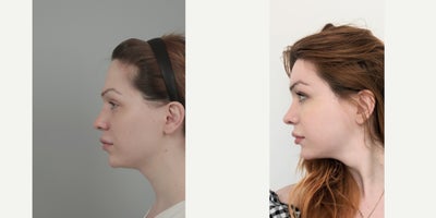 25-34 year old woman treated with AccuLift, Cheekbone Reduction, Contour Thread Lift, Facial Fat Transfer, Forehead Reduction, M - .