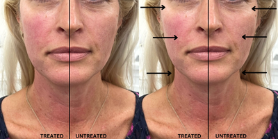 35-44 year old woman treated with Forma - After only 12 minutes of treatment time on the right half of the face, patient's skin appears lifted and more supple. Our red carpet treatment shows immediate visible improvement in fine lines, texture, and skin laxity. Feels like a warm stone massage, zero downtime, and results last ~72h.