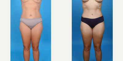 35-44 year old woman treated with Abdominal Etching, Diastasis Recti Repair, Drainless Tummy Tuck, Liposculpture, Liposuction, M - Before and after tummy tuck with lipo 360. This patient had a tummy tuck as part of her mommy makeover. She has excess skin and fat primarily below her belly button and in her suprapubic area. I did a low bikini incision removing all skin and fat from her belly button to her pubic area. I did a corset muscle plication of her stretched abdominal muscles. I did VASER ultrasound liposuction of her abdomen, flanks to shape her waist.