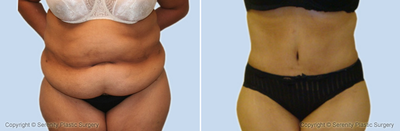 Mommy Makeover - 
	Mommy Makeover
