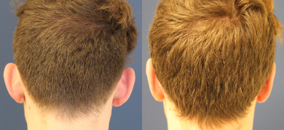 25-34 year old man treated with Ear Surgery - Otoplasty