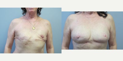 55-64 year old woman treated with  Fat Transfer for  breast reconstruction - 2 years following staged fat transfers x 4 for breast reconstruction. Also right nipple reconstruction