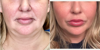 45-54 year old woman treated with Laser Liposuction, Miracu, Nonsurgical Facelift, Nonsurgical Neck Lift - Facial Rejuvenation in the hands of Dr. Jeffrey Rosenthal, requires a combination of procedures to stimulate collagen with the Endolift Laser, Lift and support sagging face, jaw and neck skin with PDO Threads (Miracu and Mint) and replace lost volume with Radiesse and RHA fillers. Harmony and Balance of the face and neck is the ideal rejuvenation.