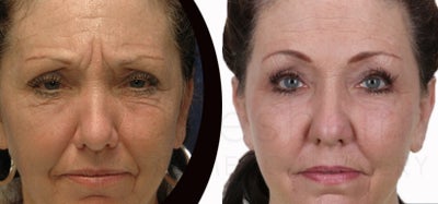 Face fat grafting with body jet (water-assisted liposuction) - 
	56 yr old woman with aging eyes. Treatment was fat grafting to lower eyelids and cheeks with fat harvested using body-jet ( water liposuction). Upper blepharoplasty, botox for brows and brow tinting also done.
