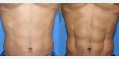TruSculpt iD - Six Pack Strategy:These photos show the results that can be achieved with truSculpt flex, just FDA-cleared for the improvement of abdominal tone, strengthening of the abdominal muscles and development of a firmer abdomen. It is also cleared for the strengthening, toning and firming of buttocks and thighs.Until now, muscle toning devices used magnets to contract muscles. The truSculpt flex technology uses direct delivery of electrical current to stimulate muscle contractions and treats specific muscle groups using three treatment mode options:  Prep Mode: creates a twisting motion to warm up, stretch the muscles and slowly build a tolerance to muscle contractions Tone Mode: contracts the muscles, holds it to the point of exhaustion and then relaxes it to increase strength and enhance endurance Sculpt Mode: fast, deep, sequential contractions of the muscles for building muscle mass.