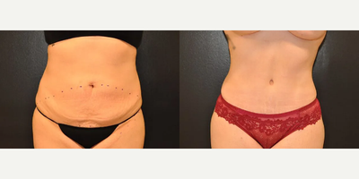 Woman treated with Tummy Tuck - Woman treated with Tummy Tuck