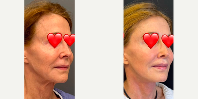 Woman treated with Facelift Revision  - Woman treated with Facelift Revision through Deep Plane Facelift as well as Neck Lift, Temporal Brow Lift, Facial Fat Transfer, and Lip Lift.