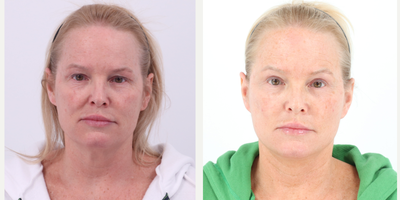 45-54 year old woman treated with Facelift, Neck Lift, Eyelid Surgery, Facial Fat Transfer, CO2 Laser - 52 year old 4 months post Facelift, Neck lift, Upper Blepharoplasty, Fat transfer and CO2 laser