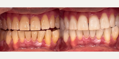 35-44 year old man treated with Zoom Whitening - 41-year-old man treated with Zoom Whitening