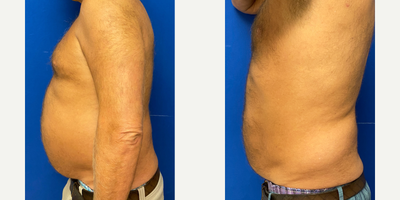 45-54 year old man treated with Ultraslim while on NAWI HCG diet program - 45-54 year old man before and after pictures following 2-months of HCG weight loss program. Daily HCG injections and weekly Ultraslims with progress and measurements.