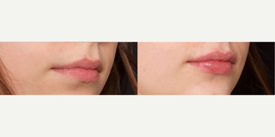 Woman treated with Restylane Kysse - Woman treated with Restylane Kysse.