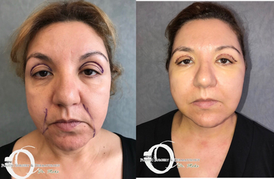 35-44 year old woman treated with Eyelid Surgery - 5 days after advanced Mehr design face and neck lift as well as upper eyelid surgery