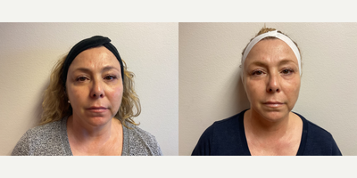45-54 year old woman treated with Morpheus8, Microneedling RF - Morpheus Microneedling- Under eye fat pads, Skin tightening, lifting and retexturizing