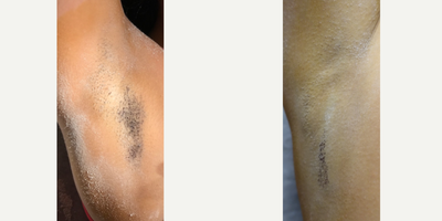 25-34 year old woman treated with miraDry - Patient iodine starch test shown before and 2 weeks after miraDry treatment.An iodine solution is applied to the skin and allowed to air-dry. Then dry the area is dusted with cornstarch. When sweat reaches the surface of the skin the starch and iodine combine causing a dramatic color change (yellow -&gt; dark blue) allowing sweat production to be actively visualized.