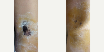 35-44 year old woman treated with miraDry - Patient iodine starch test shown before and 2 weeks after miraDry treatment.An iodine solution is applied to the skin and allowed to air-dry. Then dry the area is dusted with cornstarch. When sweat reaches the surface of the skin the starch and iodine combine causing a dramatic color change (yellow -&gt; dark blue) allowing sweat production to be actively visualized.