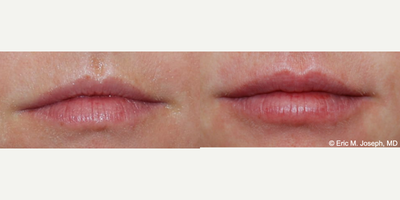 35-44 year old woman treated with Lip Surgery, Silikon 1000 - Our 35 year old patient is seen before and immediately after permanent lip augmentation with microdroplet Silikon-1000. There is typically no downtime, and results are natural looking and undone.