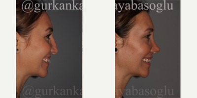 35-44 year old woman treated with Lip Repositioning, Rhinoplasty - 35-44 year old woman treated with Lip Repositioning