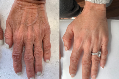 55-64 year old woman treated with Hand Rejuvenation - Patient treated with Bellafill 2 syringes in each hand for a more youthful appearance of the hands