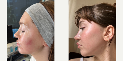 SELFIE SCARS | ACNE COMBO - Our patient has some very deep acne scars that have hurt her confidence for a long time, so she's ready to get rid of them. We did a combination treatment of punch excisions, Halo and CO2 lasers, PDO After Goo, and of course our favorite- the Emer Skin Hydration mask. Combining all of these treatments are not only going to help stimulate collagen reproduction but also help soften her acne scars as well as her skin's overall texture. Needless to say, she could not be happier with her results and is loving her smooth and rejuvenated skin.PUNCH EXCISIONHALO LASERCO2 LASERPDO AFTER GLOEMER SKIN HYDRATION MASKNo treatment is complete without EMER SKIN. Using our products post-treatment will enhance results to the absolute maximum. Click Link in Bio Click Emer Skin