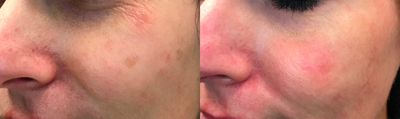 35-44 year old woman treated with Laser Resurfacing - Fractional CO2 laser resurfacing with PRP