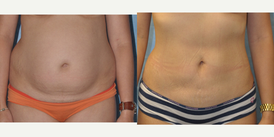 35-44 year old woman treated with Liposuction - Procedure: Liposuction of Abdomen and Flanks