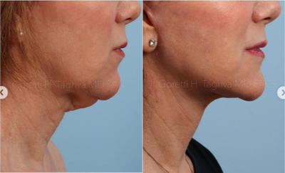Woman treated with Vivace - This beautiful patient is 3 months out from her Vivace. She was concerned about the loss of definition of her jawline and the overall laxity in her face and neck region.