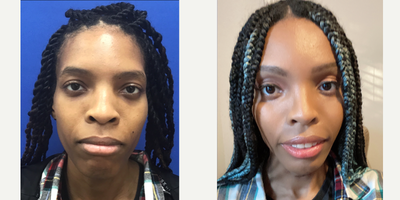 Patient treated with Cheek Augmentation - Cheek Implants (Small) - 25 to 34 year-old female patient is 5 months post-op from Facial Feminization surgery. Her procedures included: Forehead Lift, Hairline Lowering, Orbital Bony Contouring; Septorhinoplasty (closed) with Weirs, Cartilage Grafts, Radix Graft; Cheek Implants (Small); Chin Implant (Central) with Chin Reduction and Contour; Fascia to Upper Lip; Thyroid Cartilage Shave and Voice Feminization.