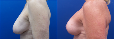 55-64 year old woman treated with Mentor Breast Implants - 60-year-old patient underwent wise pattern revision mastopexy (breast lift) and breast implant exchange with Mentor smooth round 230cc moderate profile saline implants.