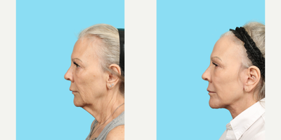 63 year old woman treated with Phenol Peel - This 63-year-old woman was bothered by droopy eyes, lip lines around her mouth and a sagging jawline. The doctor performed facelift, neck lift, upper blepharoplasty and a phenol chemical peel around her mouth. Her results are dramatic and she looks 10 years younger.