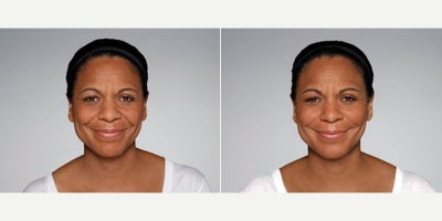 Woman treated with Restylane Defyne - 1.0 mL Restylane Defyne in nasolabial folds1.0 mL Restylane Refyne in marionette lines2.5 mL Restylane Lyft in cheeksPhotos taken before treatment and 2 weeks after treatment