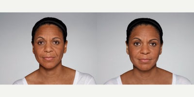 Woman treated with Restylane Defyne - 1.0 mL Restylane Defyne in nasolabial folds1.0 mL Restylane Refyne in marionette lines2.5 mL Restylane Lyft in cheeksPhotos taken before treatment and 2 weeks after treatment