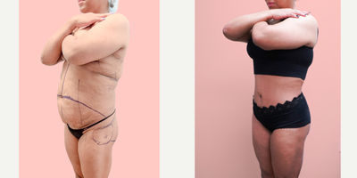 35-44 year old woman treated with Tummy Tuck, Tumescent Liposuction, Vaser Liposuction, Brazilian Butt Lift - This wonderful patient wanted to improve her curves, flatten her abdomen and reshape her torso. She is shown 3 months after 360 liposuction, tummy tuck and brazilian butt lift.