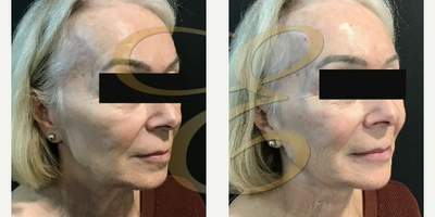 Woman treated with Restylane, Radiesse, Juvederm - Woman treated with Restylane, Radiesse, Juvederm