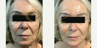 Woman treated with Restylane, Radiesse, Juvederm - Woman treated with Restylane, Radiesse, Juvederm