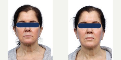 Woman treated with Skin Tightening with XERF - Woman treated with Skin Tightening with XERF